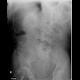 Pancolitis, colitis, severe: X-ray - Plain radiograph